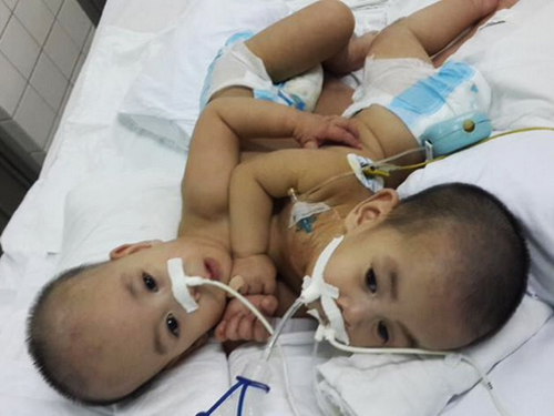 Hai bé song sinh dính nhau quê Ninh Thuận trước khi được phẫu thuật tại Bệnh viện Nhi Đồng 2, TP HCM