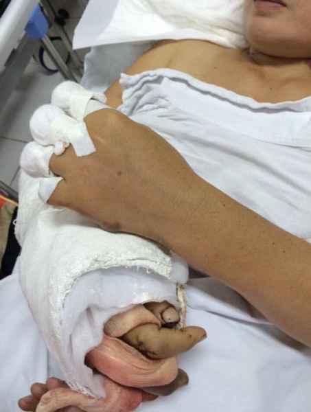 Nạn nhân Lê Thị Khai bị đứt 5 ngón tay không thể nối lại, đang điều trị tại Hà Nội