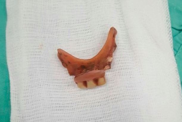 Bệnh nhân nuốt hàm răng giả vào thực quản mà không biết