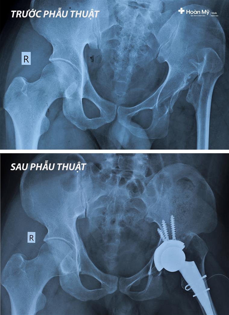 Hình ảnh X Quang bệnh nhân trật khớp háng trước và sau khi đã phẩu thuật